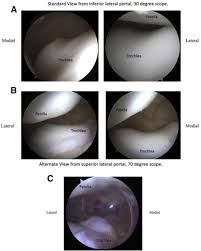 Image result for Patella Tracking Assessment