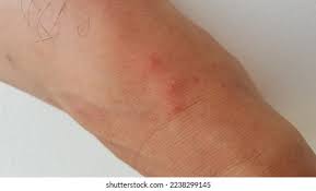 Image result for ant bite
