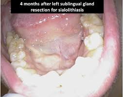 Image result for Sialolithiasis