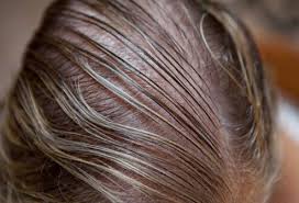 Androgenetic alopecia is progressive for both men and women, meaning hair loss worsens over time. Women S Hair Loss Causes Treatments And Solutions