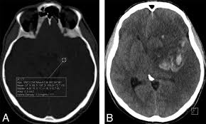 Iodine Extravasation Quantification On Dual Energy Ct Of The Brain Performed After Mechanical Thrombectomy For Acute Ischemic Stroke Can Predict Hemorrhagic Complications American Journal Of Neuroradiology