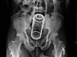 I interfaced. xr is a robotic space ranger who was originally created by the lgms to be buzz lightyear's new partner, but wound up becoming a member of team lightyear and the first official robot ranger in star command. X Rays Of Objects Stuck In Really Strange Places 30 Pics Izismile Com