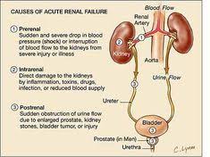 Arf Prerenal Has High Bun Creat Ratio But Low Fena And Low Fe Urea 2 And Fe Urea 35 Nurse Nursing Students Dialysis Nurse