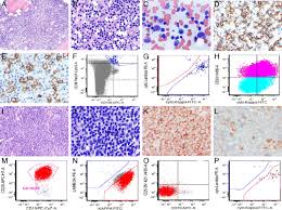 Waldenstrom Macroglobulinemia With Extramedullary Involvement At Initial Diagnosis Portends A Poorer Prognosis Journal Of Hematology Oncology Full Text