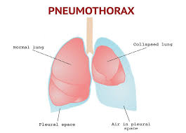 Image result for Pneumothorax