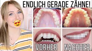Und so funktioniert die schienentherapie mit der harmonieschiene von orthos. Vorher Nachher So Sehen Meine Zahne Jetzt Aus Meine Erfahrung Mit Invisalign Thebeauty2go Youtube