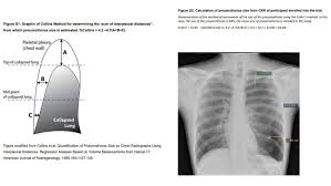 Symptoms of pneumothorax include shortness of breath, chest pain on one side and experiencing pain when breathing. Conservative Treatment For Primary Spontaneous Pneumothorax First10em
