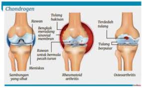 Penyebab itu bisa karena kulit kering maupun. Suntikan Sel Stem Penawar Sakit Lutut