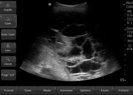 In controlled settings ultrasound may detect constitutive pleural fluid, can reliably detect effusions >20 ml in clinical settings, and may approach the sensitivity and specificity of computed tomography. Tuberculous Pleural Effusion Shaw 2019 Respirology Wiley Online Library