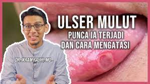 Untuk mencegah ulser juga boleh dibuat dengan mengamalkan makanan. 4 Cara Hilangkan Ulser Mulut Bagaimana Ulser Terjadi Bibir Lelangit Mulut Dan Lidah Youtube