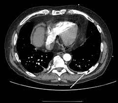 pleural plaques are evidence of past asbestos exposure and it is the asbestos exposure itself that can cause more severe disease. View Of Pleural Plaques And Effusion In A Patient Exposed To Asbestos The Southwest Respiratory And Critical Care Chronicles