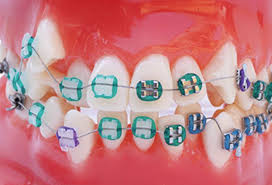 Here are some ways to manage rubber bands and to understand why rubber bands are an important part of your orthodontic treatment, you'll first need to know how all the components of braces work together. How Long Does The Braces Pain Last Quora