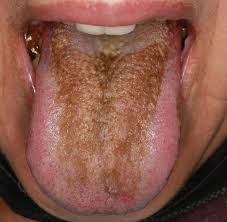Image result for black hairy tongue symptoms