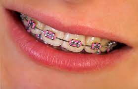 Razdolsky can help you better. How Braces Work To Straighten Your Teeth