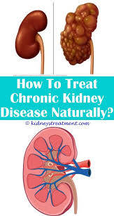 Proteinuria Kidney Disease In 2020 Kidney Disease Symptoms Kidney Disease Kidney Failure Treatment