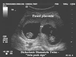 Check out our lambda symbol selection for the very best in unique or custom, handmade pieces from our shops. Pin On Obstetric Ultrasound