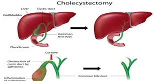 How long is recovery after open heart surgery? Cholecystectomy Gallbladder Removal Conditions Treated Procedure Types Recovery