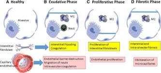 Most people who develop ards are in the hospital for other serious health problems. Biomarkers For Acute Respiratory Distress Syndrome And Prospects For Personalised Medicine Journal Of Inflammation Full Text
