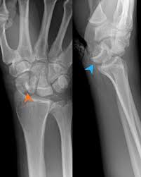 Image result for Scapholunate Dislocation