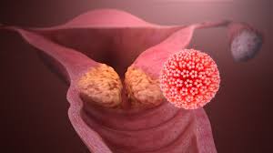 O câncer no útero é dividido em sarcoma uterino, câncer de colo do útero e câncer de endométrio, ou seja, todos começam no neste conteúdo, vamos conhecer pelo menos 9 prováveis sintomas de câncer no útero e explicar cada um deles para que você possa. Cancer De Cuello Uterino Cervical Causas Y Sintomas