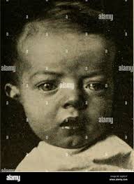 Image result for Craniotabes