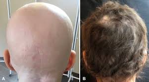 A person with alopecia universalis has no eyebrows, eyelashes. Treatment Of Severe Alopecia Areata With Baricitinib Jaad Case Reports