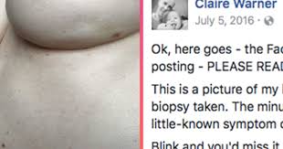 Inflammatory breast cancer is an infrequent, aggressive type of breast cancer that spreads rapidly. Claire Warner S Photo Shows A Symptom Of Breast Cancer Attn