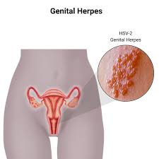 Image result for genital herpes