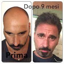 Hair Transplantation In 2021 Best Hair Transplant Hair Transplant Before After Hair