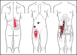 This muscle is a major generator of lower back and hip pain, as well as being responsible for complaints of a burning sensation along the posterior superior iliac spine (psis) and sacroiliac joint. Psoas Muscle The Hidden Cause Of Lower Back Pain Matheson Chiropractic Clinic