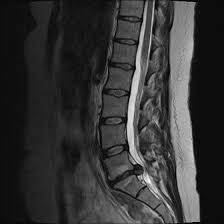 Ein bandscheibenvorfall (bandscheibenprolaps) kann starke schmerzen auslösen. Bandscheibenvorfall Der Lendenwirbelsaule Ursachen Diagnose Und Behandlung In Der Praxisklinik Orthospine