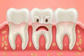 Image result for Gingivitis