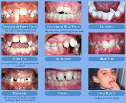 At this point, pretty much all of your child's baby teeth will have fallen out and he'll have his permanent ones. Why Visit An Orthodontist By Age 7 L M Orthodontics Orthodontists In Doylestown Glenside Perkasie Pa Warrington Bucks County Montgomery County