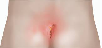 A pilonidal cyst is almost always located near the tailbone at the top of the cleft of the buttocks. Surgery For Pilonidal Sinus Healthdirect