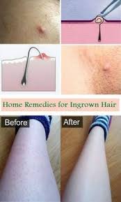 It might take a time to coax that curly facial hair closer to the surface, just avoid digging into the skin for it. 47 Ingrown Hairs Ideas Ingrown Hair Ingrown Hair Removal Ingrown Hair Remedies