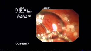 Barnemark er en parasitt som lever i tarmsystemet hos mennesker, og som smitter lett. Her Er 7 Parasitter Som Lever Av Kroppen Din Illvit No