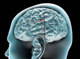 Simptomele anevrismului cerebral la fiecare pacient pot fi diferite. Anevrismul Cerebral Èi Simptomele Care Trebuie SÄ VÄ TrimitÄ La Doctor