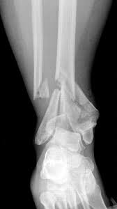 Knee muscles need to have both good strength and flexibility. X Rays Ct Scans And Mris Orthoinfo Aaos