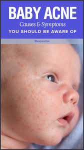 Sweat pimples are caused by the build up of heat in the body which water can help prevent when consumed. Baby Acne What Causes Them And How You Can Prevent Baby Acne Baby Acne Remedy Baby Rash