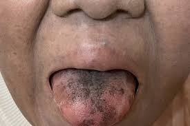 Image result for black hairy tongue symptoms