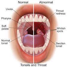 What are some good home remedies for tonsillitis? How I Treated My Chronic Tonsillitis Patient S Lounge