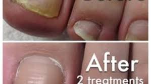 fungal nail infection removal rachels