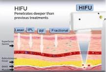 Image result for what is exilis skin treatment same as high frequency