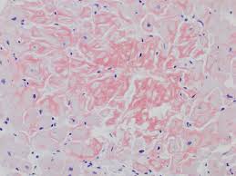 Signs and symptoms may include diarrhea. Trends In Diagnostic Imaging Of Cardiac Amyloidosis Emerging Knowledge And Concepts Radiographics