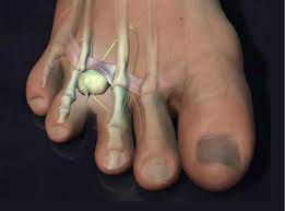 Accurate Education Morton S Neuroma
