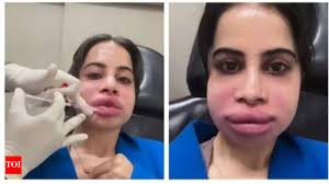 Urfi Javed: Uorfi Javed gets her lip fillers dissolved after 9 years,  shares pictures of her swollen face | - Times of India