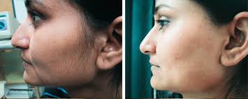 The laser hair removal process is, by definition, a procedure that makes use of laser or concentrated light beam to get rid of unwanted hair in since it has become a regular appointment for some, it is essential to take note of the changing cost of laser hair removal. Laser Hair Removal London London Premier Laser Clinic