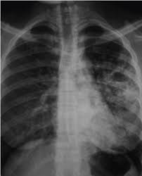 We also attempt to categorize the findings into those definitive for active tb, indeterminate for disease activity, and those indicating healed tb. The Radiological Diagnosis Of Pulmonary Tuberculosis Tb In Primary Care