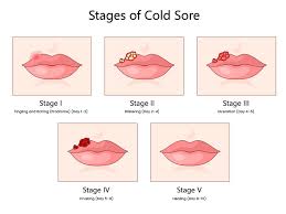 Image result for oral herpes symptoms roof of the mouth