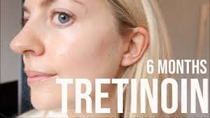 We did not find results for: 6 Month Tretinoin Retin A Update Acne Acne Scars Wrinkles Youtube